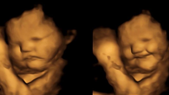 A 4D image of what appears to be a smiling foetus on the right and relaxed on the left